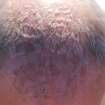 sunburn on the head of a man